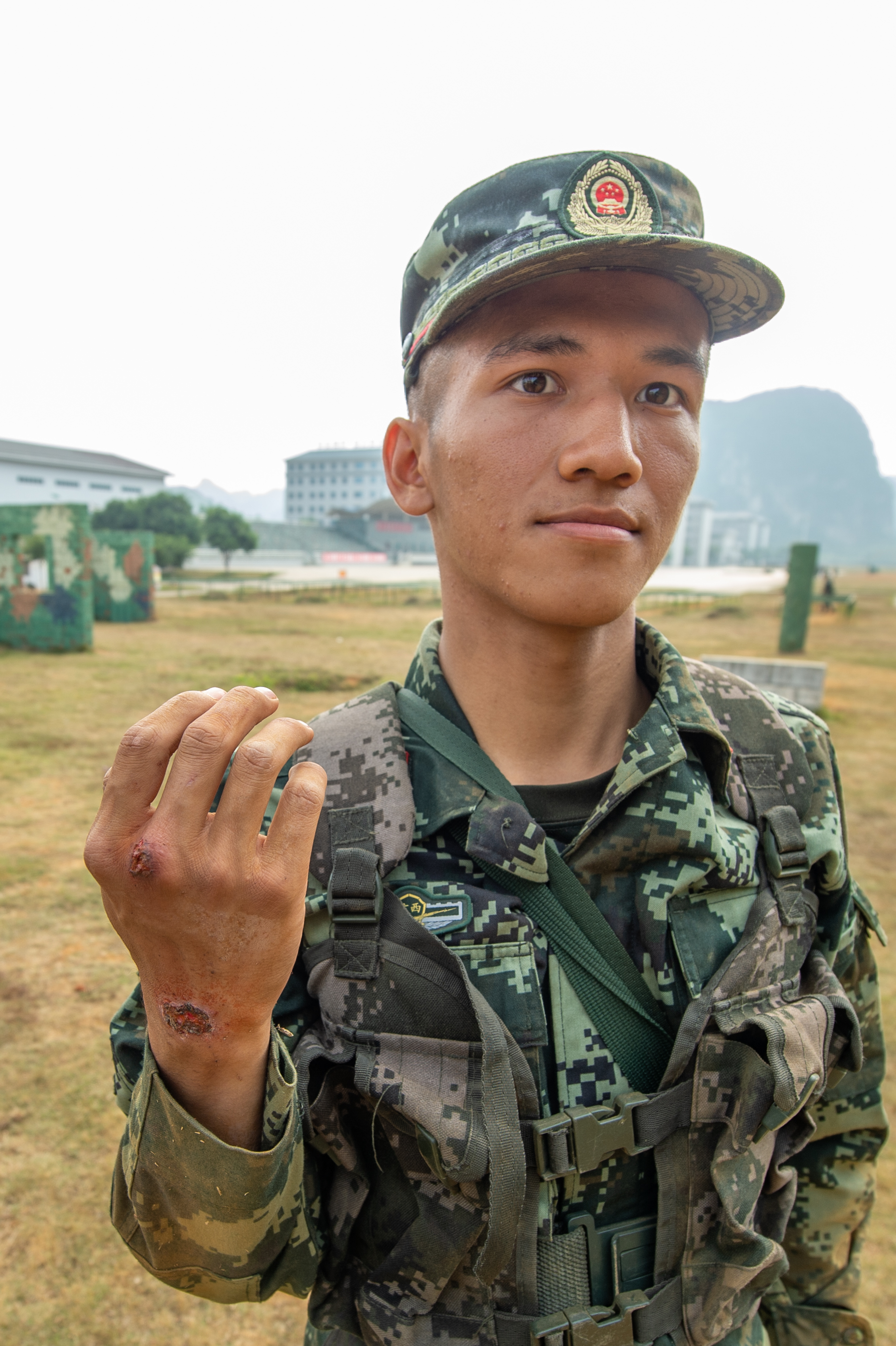 2020年11月16日，一名武警新兵手部多處留下傷疤。