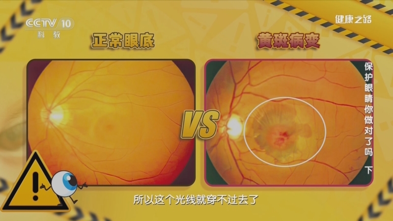 [健康之路]保护眼睛你做对了吗（下） 传言五：只有老年人会得黄斑病变