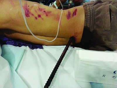 命大活了下来          ①失足从三楼坠下 钢筋被腰带裹 着头刺入身体