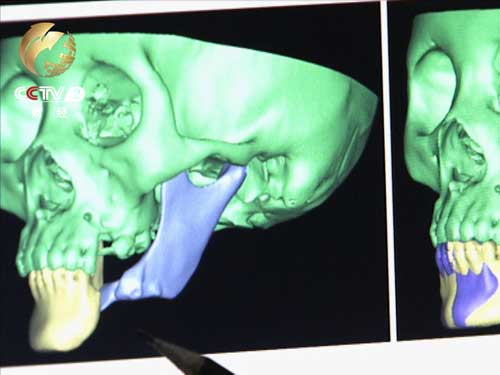 刘彦普决定运用3D技术为小景进行植骨手术