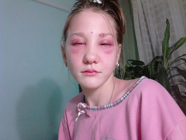 俄一女孩在美容院染睫毛 眼部灼伤毁容失明(图)