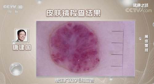 色素瘤是怎么样的 2019120514554147270.jpg