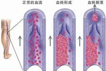 如何預(yù)防“經(jīng)濟(jì)艙綜合征”？照這四個(gè)字做